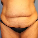 Tummy Tuck Before & After Patient #6597
