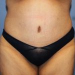Tummy Tuck Before & After Patient #6597
