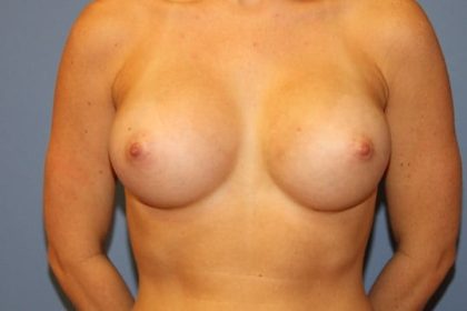 Breast Augmentation Before & After Patient #7098