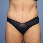 Tummy Tuck Before & After Patient #6596
