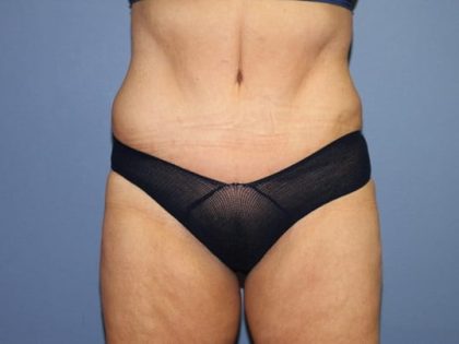 Tummy Tuck Before & After Patient #6596