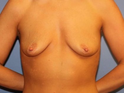 Breast Augmentation Before & After Patient #7054