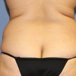 Liposuction Before & After Patient #5866