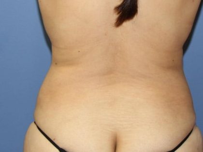 Liposuction Before & After Patient #5867