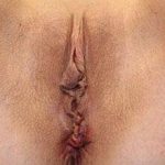 Labiaplasty Before & After Patient #6728