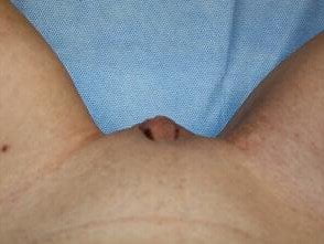 Clitoral Hood Reduction Before & After Patient #6689