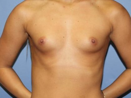 Breast Augmentation Before & After Patient #7096