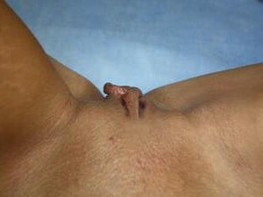 Labiaplasty Before & After Patient #6723