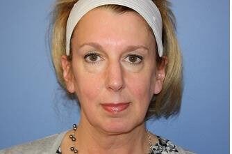 Facelift Before & After Patient #6649