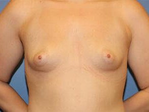 Tuberous Breast Correction Before & After Patient #7608