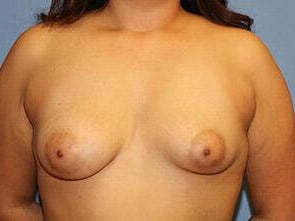 Tuberous Breast Correction Before & After Patient #7587