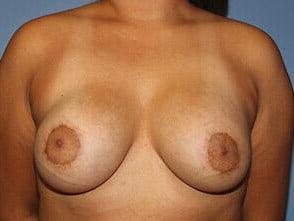 Tuberous Breast Correction Before & After Patient #7587