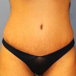 Tummy Tuck Before & After Patient #6595