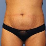 Tummy Tuck Before & After Patient #6594
