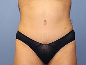 Tummy Tuck Before & After Patient #6594
