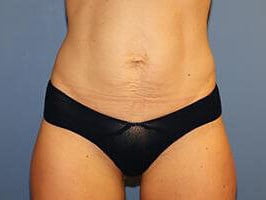 Tummy Tuck Before & After Patient #6592