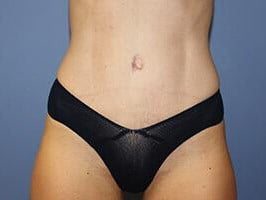 Tummy Tuck Before & After Patient #6592