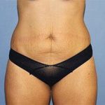 Tummy Tuck Before & After Patient #6591