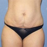 Tummy Tuck Before & After Patient #6590