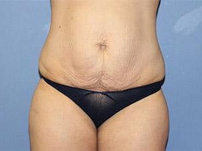 Tummy Tuck Before & After Patient #6590
