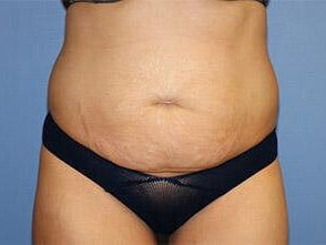 Tummy Tuck Before & After Patient #6589