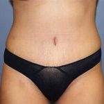Tummy Tuck Before & After Patient #6589