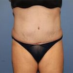 Tummy Tuck Before & After Patient #6534