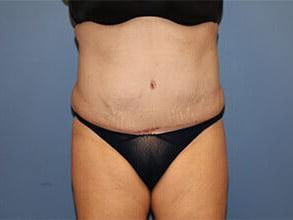 Tummy Tuck Before & After Patient #6534