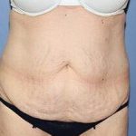 Tummy Tuck Before & After Patient #6533