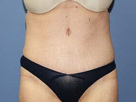 Tummy Tuck Before & After Patient #6533