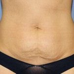 Tummy Tuck Before & After Patient #6529