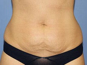 Tummy Tuck Before & After Patient #6529
