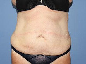 Tummy Tuck Before & After Patient #6532