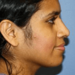 Rhinoplasty Before & After Patient #6714