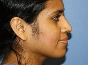Rhinoplasty Before & After Patient #6714