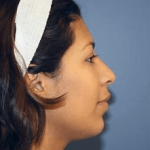 Rhinoplasty Before & After Patient #6599