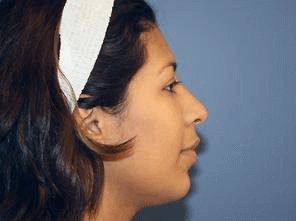 Rhinoplasty Before & After Patient #6599