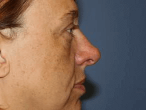 Rhinoplasty Before & After Patient #6712