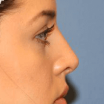 Rhinoplasty Before & After Patient #6711