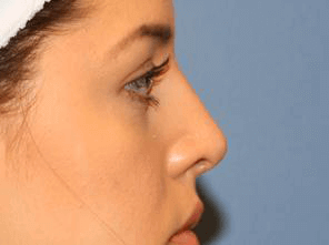 Rhinoplasty Before & After Patient #6711