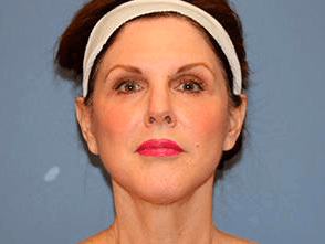 Facelift Before & After Patient #6647