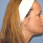 Facelift Before & After Patient #6646