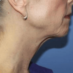 Facelift Before & After Patient #6645