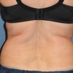 Breast Augmentation Before & After Patient #6286