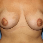 Breast Lift Before & After Patient #6826