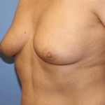Breast Lift Before & After Patient #6825