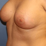 Breast Lift Before & After Patient #6825