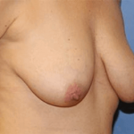 Breast Lift Before & After Patient #6831