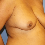 Breast Lift Before & After Patient #6832