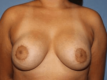 Breast Lift Before & After Patient #6833